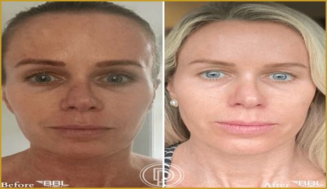 Rollie BBL Before And After Photo: Surgery Update 2023